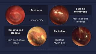 Acute Otitis Media Otoscopic Findings [upl. by Salta354]