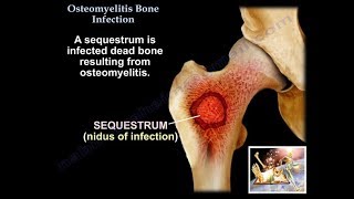 Osteomyelitis Bone Infection  Everything You Need To Know  Dr Nabil Ebraheim [upl. by Nebe]