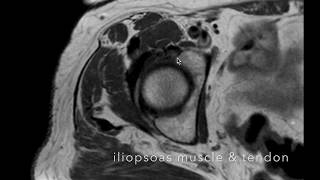 Snapping Hip Syndrome [upl. by Treva]