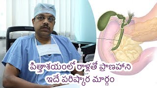 Gall Bladder Stones  Causes amp Treatment  Samayam Telugu [upl. by Dib]