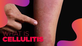 What is Cellulitis  Symptoms and Treatment Options [upl. by Nageam703]