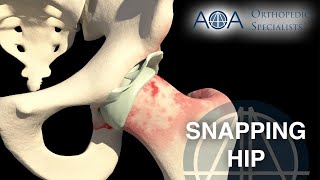 AOA Orthopedic Specialists  Snapping Hip [upl. by Newbill]