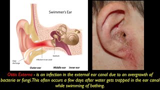 Otitis Externa PEV [upl. by Aubin394]